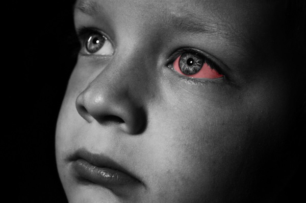 How Do Toddlers Get Pink Eye?